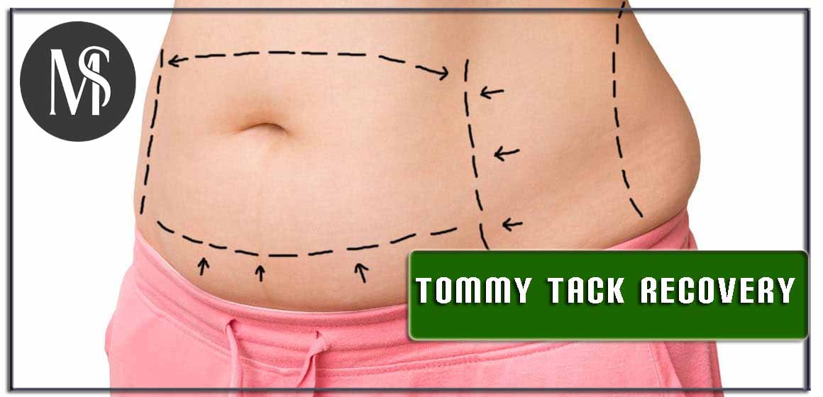 Tummy Tack Recovery: Duration, Tips, and More